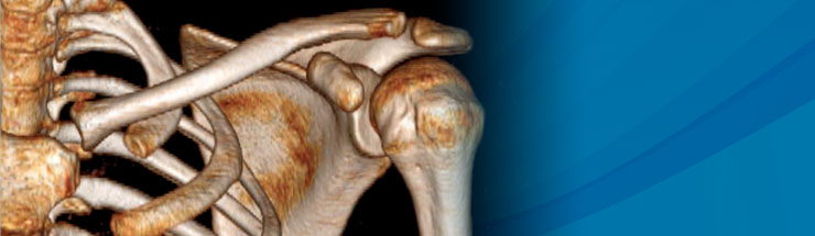 Artroplastia de umăr descrisă de Dr. Gavrilă - medic ortoped